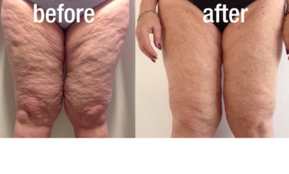 Фотона Боди 1